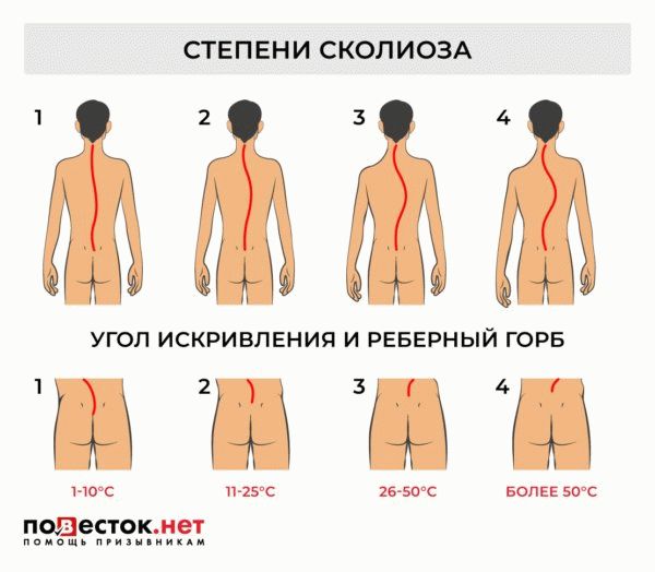 С каким сколиозом не берут в армию?